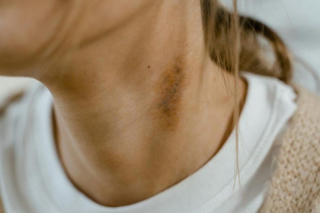 Detailed close-up image of a neck showing a visible bruise or scar, emphasizing skin texture.